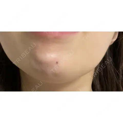 ボトックス（あご） A CLINIC（エークリニック） 新宿院 DAY 0