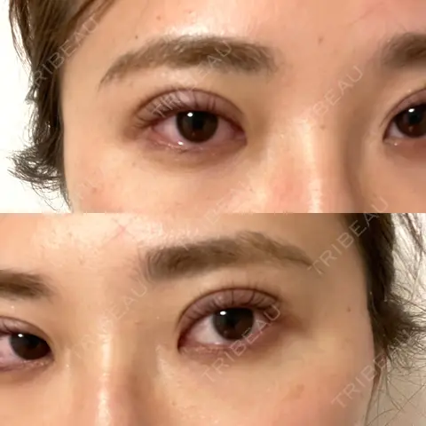 二重埋没 Brandnew Beauty Clinic DAY 0