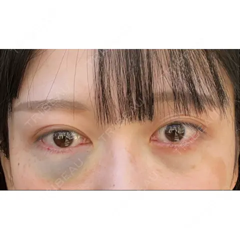 下まぶたの脂肪取り APOLLO BEAUTY CLINIC DAY 0
