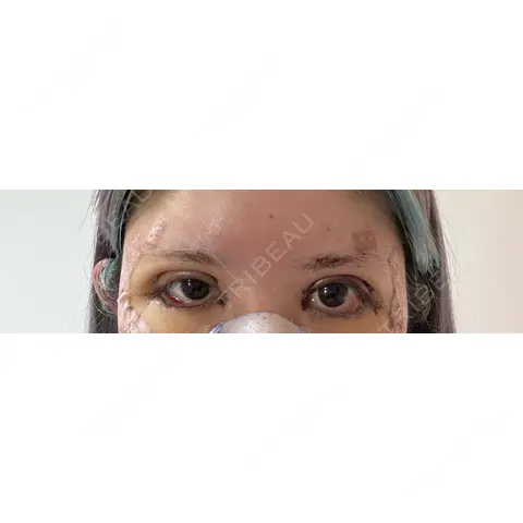 クマ治療 / タレ目形成・グラマラスライン（切開） R Beauty CLINIC 銀座院 DAY 8