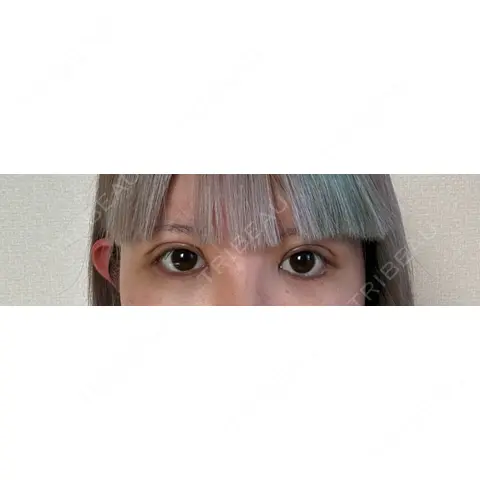 クマ治療 / タレ目形成・グラマラスライン（切開） R Beauty CLINIC 銀座院 AFTER