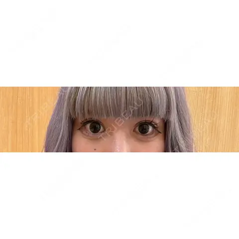 クマ治療 / タレ目形成・グラマラスライン（切開） R Beauty CLINIC 銀座院 AFTER