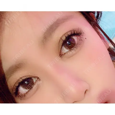 二重埋没 / 目頭切開 トアロード形成美容クリニック AFTER