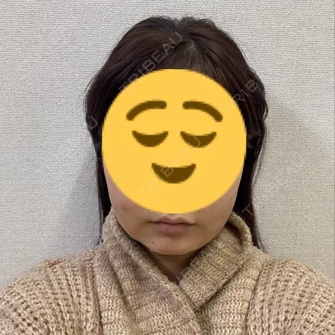 バッカルファット除去 / 脂肪吸引（顔） / ボトックス（エラ・小顔） R Beauty CLINIC 銀座院 DAY 1