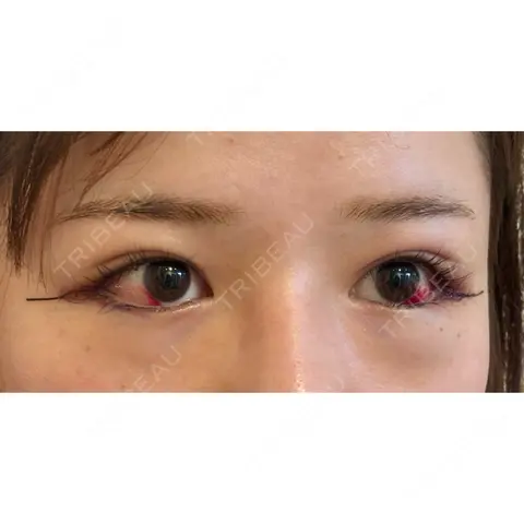 目尻切開 くさのたろうクリニック DAY 1