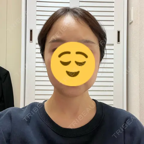 骨切り（あご） / 骨削り（エラ） / 骨削り（頬） セギム美容整形外科 DAY 31