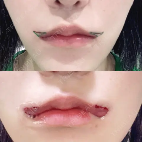 口角挙上 くさのたろうクリニック DAY 0