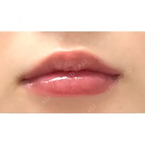 ヒアルロン酸注入（唇） 大阪TAクリニック AFTER