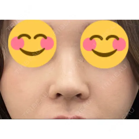 鼻尖形成（切開） / 小鼻縮小（切開） / 骨切幅寄せ / ワシ鼻修正・ハンプ切除 セギム美容整形外科 DAY 30