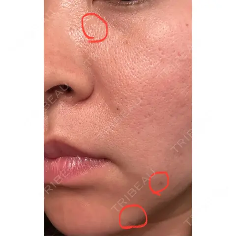 ほくろ・いぼ除去レーザー（肌） Mavie Beauty Clinic （マヴィービューティークリニック） AFTER
