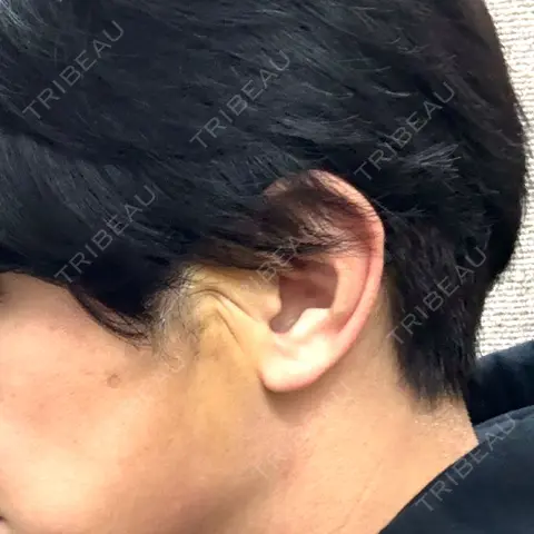 糸リフト / ヒアルロン酸注入（鼻翼基部） Tokyo Tensei Clinic 新宿院 AFTER