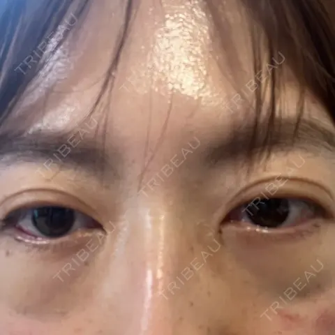 下まぶたの脂肪取り APOLLO BEAUTY CLINIC DAY 1