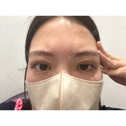 二重埋没 R Beauty CLINIC 大阪院 DAY 0