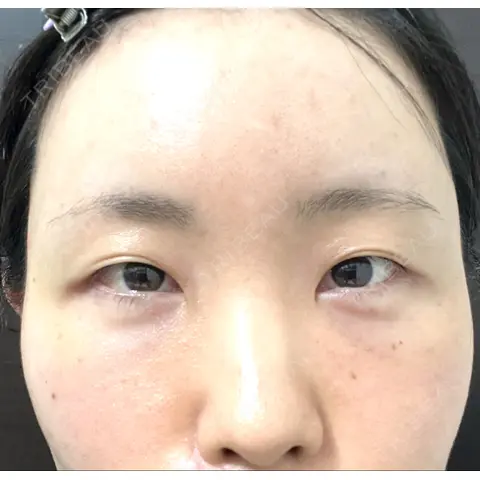 クマ治療 / こめかみ形成 / 脂肪注入（額） / 脂肪注入（目の下） / ボトックス（額） X CLINIC 銀座院 AFTER