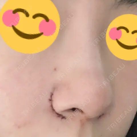 鼻尖形成（切開） / 小鼻縮小（切開） / 鼻尖縮小 品川美容外科 大宮院 DAY 0