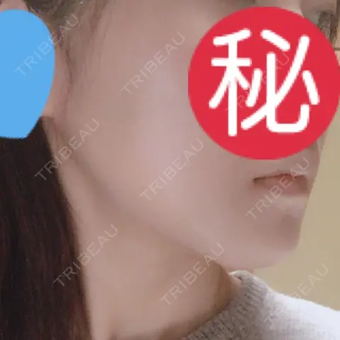 骨削り（エラ） / 骨削り（頬） リラ・クラニオフェイシャル・クリニック AFTER