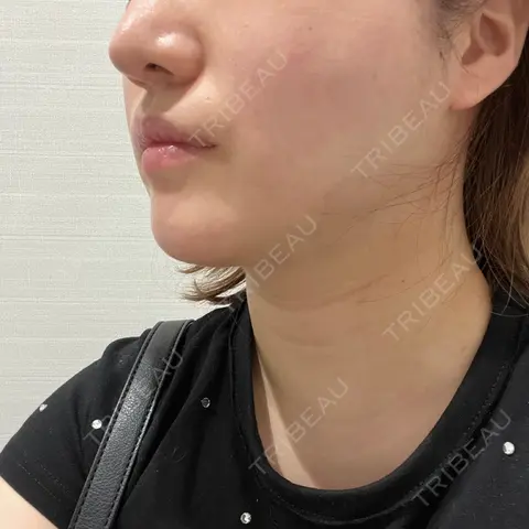 糸リフト R Beauty CLINIC 名古屋院 DAY 0