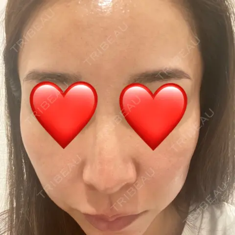 イオン導入 / 毛穴洗浄（ハイドラフェイシャルなど） R Beauty CLINIC 名古屋院 AFTER