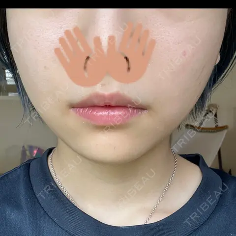 赤み除去レーザー ziz CLINIC AFTER