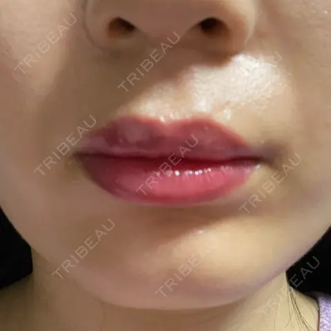 アートメイク（唇） Kinshicho Beauty Clinic （錦糸町ビューティークリニック） DAY 0