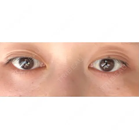 下まぶたの脂肪取り APOLLO BEAUTY CLINIC AFTER