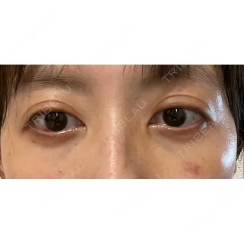 下まぶたの脂肪取り APOLLO BEAUTY CLINIC AFTER