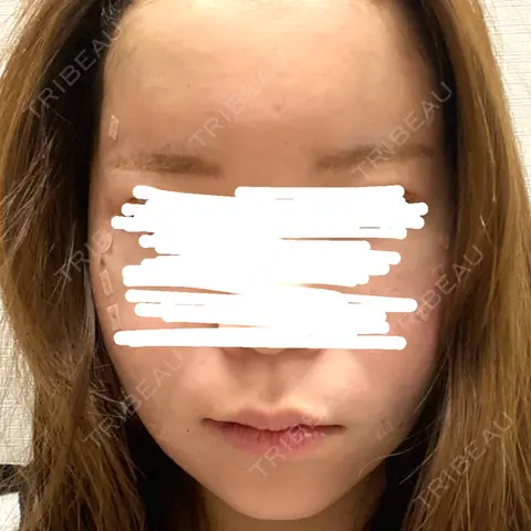 糸リフト / 脂肪吸引（顔） R Beauty CLINIC 大阪院 DAY 0