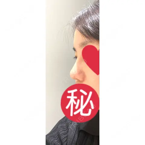 隆鼻術 / 鼻尖形成（切開） / 軟骨移植 / 骨切幅寄せ / 眉間プロテーゼ LUHO（ルホ）美容外科 AFTER