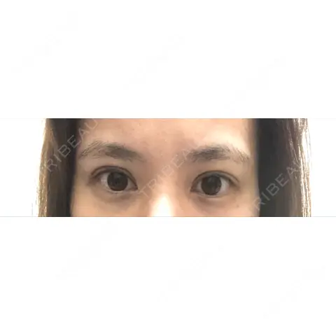 二重埋没 / 上まぶたの脂肪取り 藤・ナチュレ美容クリニック 恵比寿院 DAY 0