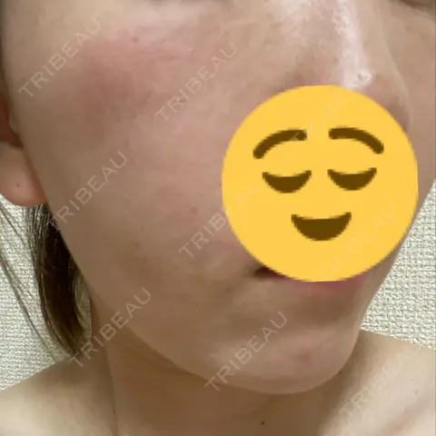 ヒアルロン酸注入（頬） AI Beauty Clinic （エーアイ美容クリニック） AFTER