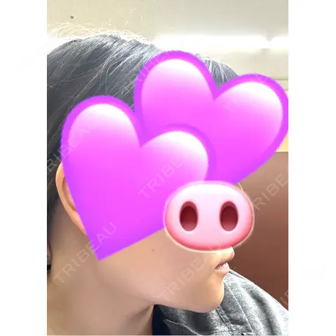 ボトックス（エラ・小顔） / ボトックス（口角） ビューティースキンクリニック 池袋院 AFTER