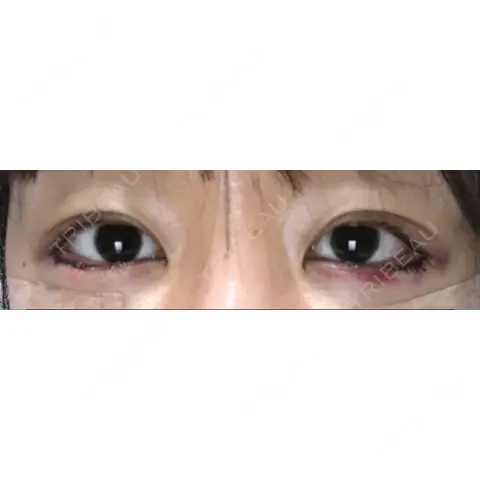 目尻切開 / タレ目形成・グラマラスライン（切開） DIVINE（ディバイン）整形外科 DAY 0
