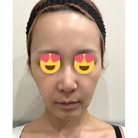 ヒアルロン酸注入（鼻翼基部） HAAB×DREAM BEAUTY CLINIC 東京本院 AFTER