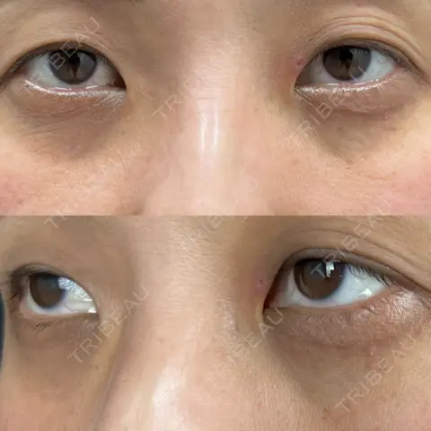 クマ治療 / 下まぶたの脂肪取り AI Beauty Clinic （エーアイ美容クリニック） DAY 0