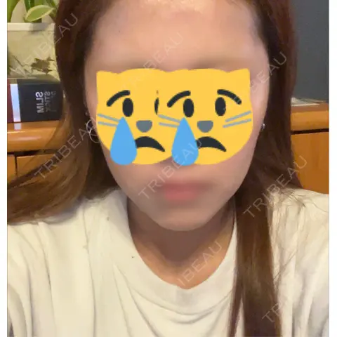 ボトックス（エラ・小顔） KARIS beauty clinic AFTER