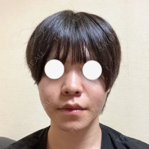 骨切り（あご） / 骨削り（エラ） / 骨削り（頬） / 人中短縮 セギム美容整形外科 DAY 61
