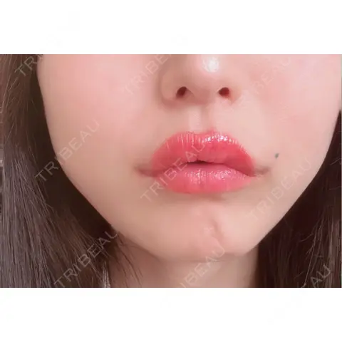 口角挙上 アネシス美容クリニック AFTER