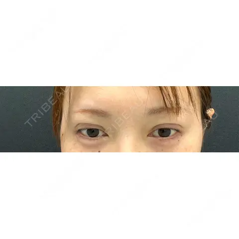 二重埋没 / ヒアルロン酸注入（涙袋） AI Beauty Clinic （エーアイ美容クリニック） DAY 0