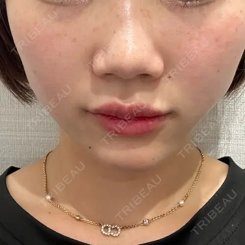 糸リフト R Beauty CLINIC 名古屋院 DAY 0