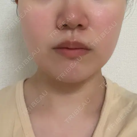 ハイフ（顔） lime clinic （杏クリニック） DAY 0