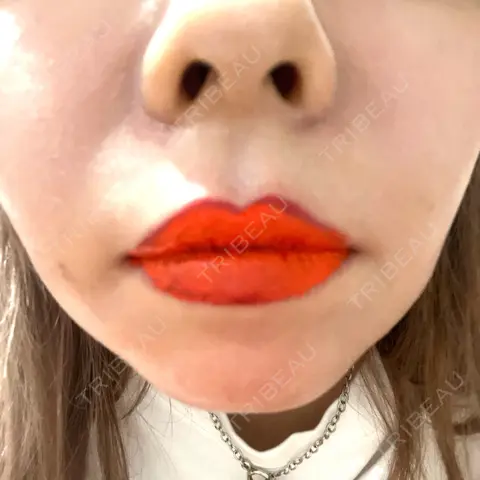 その他（口元） にしまき美容スキンクリニック DAY 0