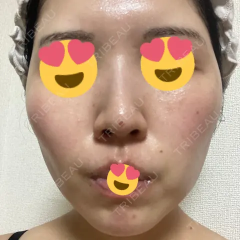 鼻尖形成（非切開） TCB東京中央美容外科 名古屋駅前院 AFTER