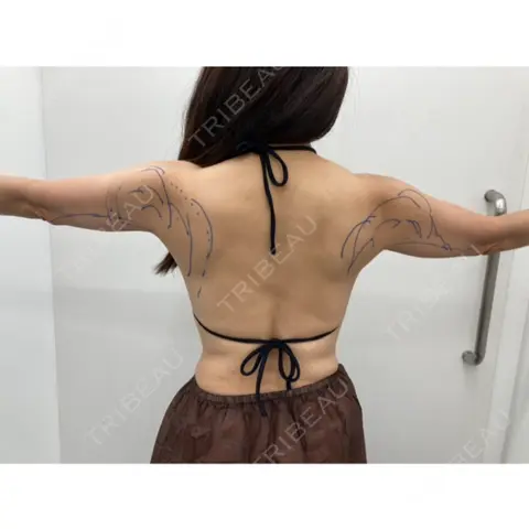 脂肪吸引（二の腕） / 脂肪注入（額） 湘南美容クリニック 金山院 DAY 0