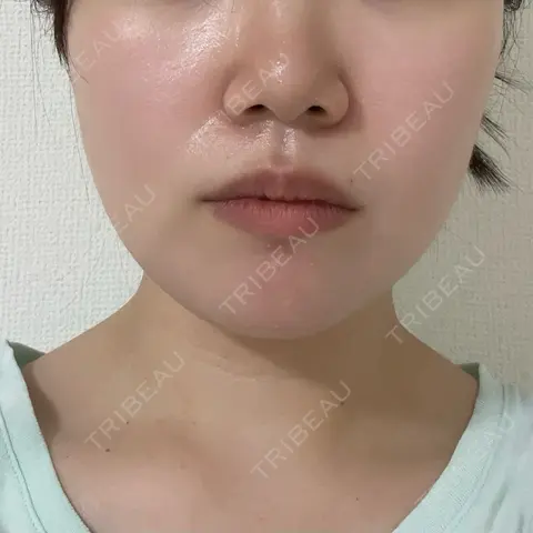 ハイフ（顔） lime clinic （杏クリニック） AFTER