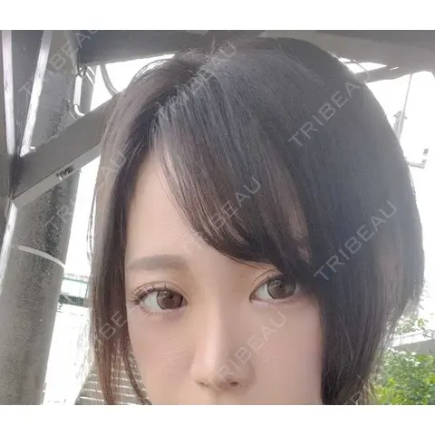 クマ治療 / 下まぶたたるみ取り / ボトックス（あご） / ヒアルロン酸注入（あご） / ヒアルロン酸注入（目の下） / ヒアルロン酸注入（鼻翼基部） / スネコス Tokyo Tensei Clinic 新宿院 AFTER