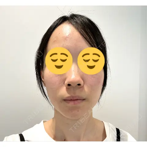 イオン導入 / 毛穴洗浄（ハイドラフェイシャルなど） R Beauty CLINIC 名古屋院 AFTER