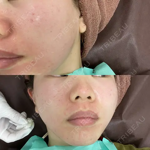 ポテンツァ DAILY SKIN CLINIC 福岡院 DAY 0