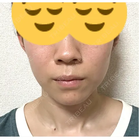 イオン導入 / 毛穴洗浄（ハイドラフェイシャルなど） R Beauty CLINIC 名古屋院 AFTER