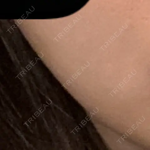 脂肪溶解注射（顔） TCB東京中央美容外科 草津院 AFTER