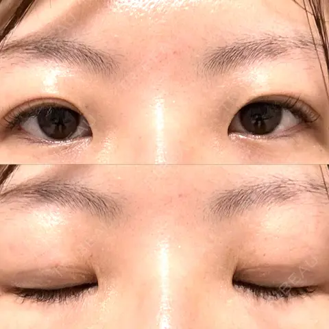 二重埋没 TCB東京中央美容外科 心斎橋院 AFTER